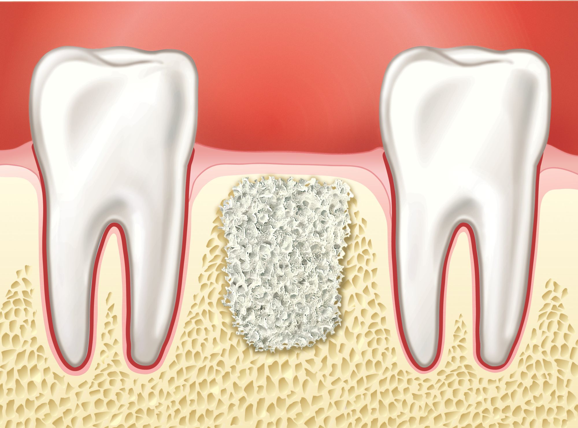 Зуб без кости. Синус-лифтинг костная пластика. Синус-лифтинг (костная пластика, остеопластика) закрытый. Костная пластика (остеопластика). Остеопластика в стоматологии.